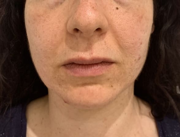photothérapie acné marseille