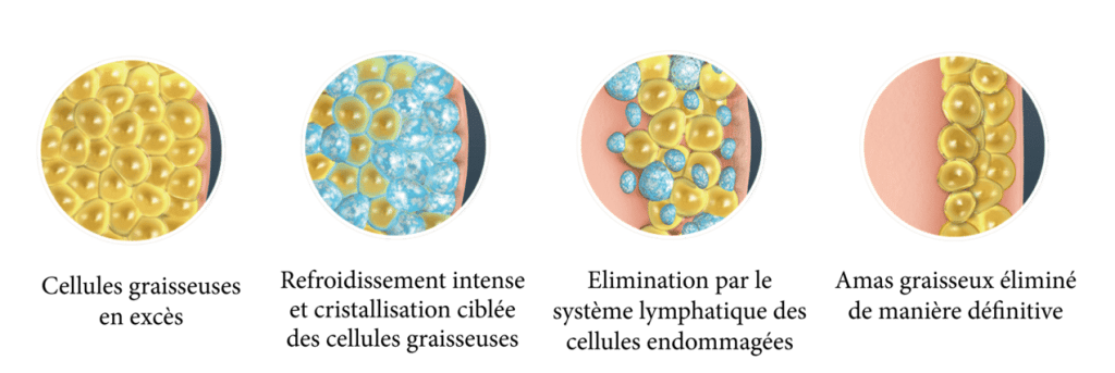 cryolipolyse marseille