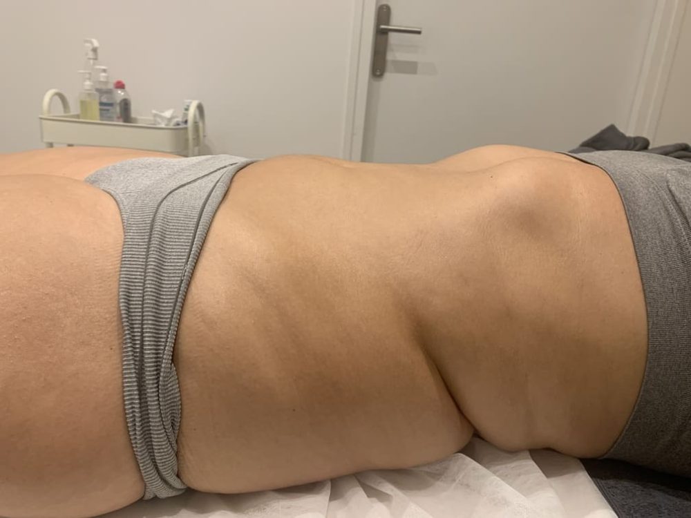 après drainage lymphatique méthode renata franc