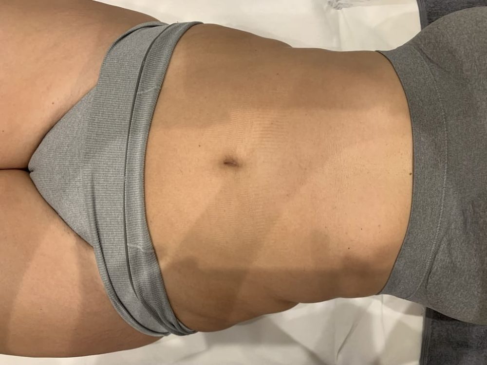 avant drainage lymphatique methode renata franca