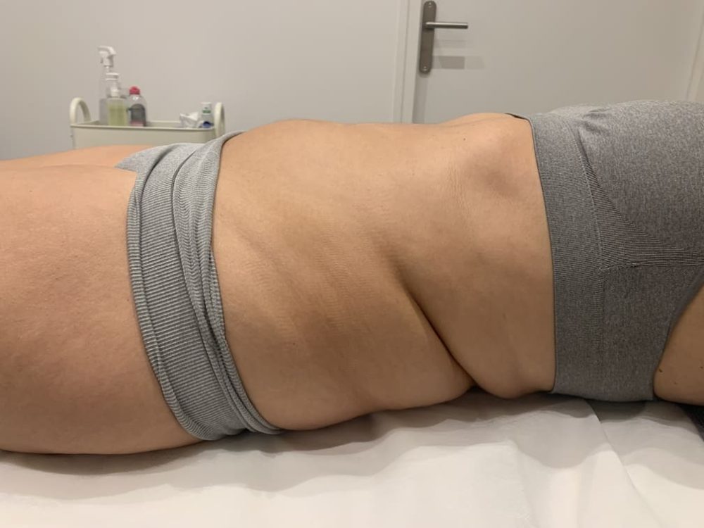 avant drainage lymphatique methode renata franca