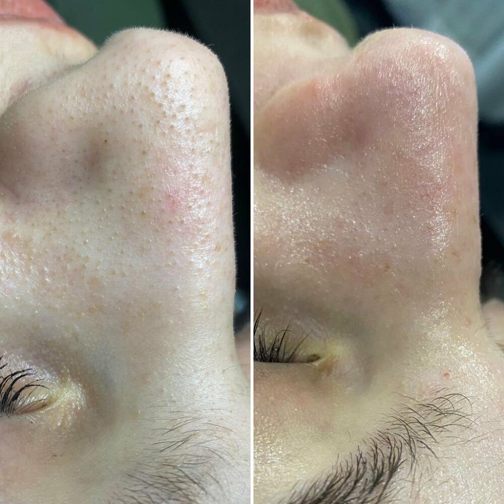 avant apres hydrafacial soin visage marseille
