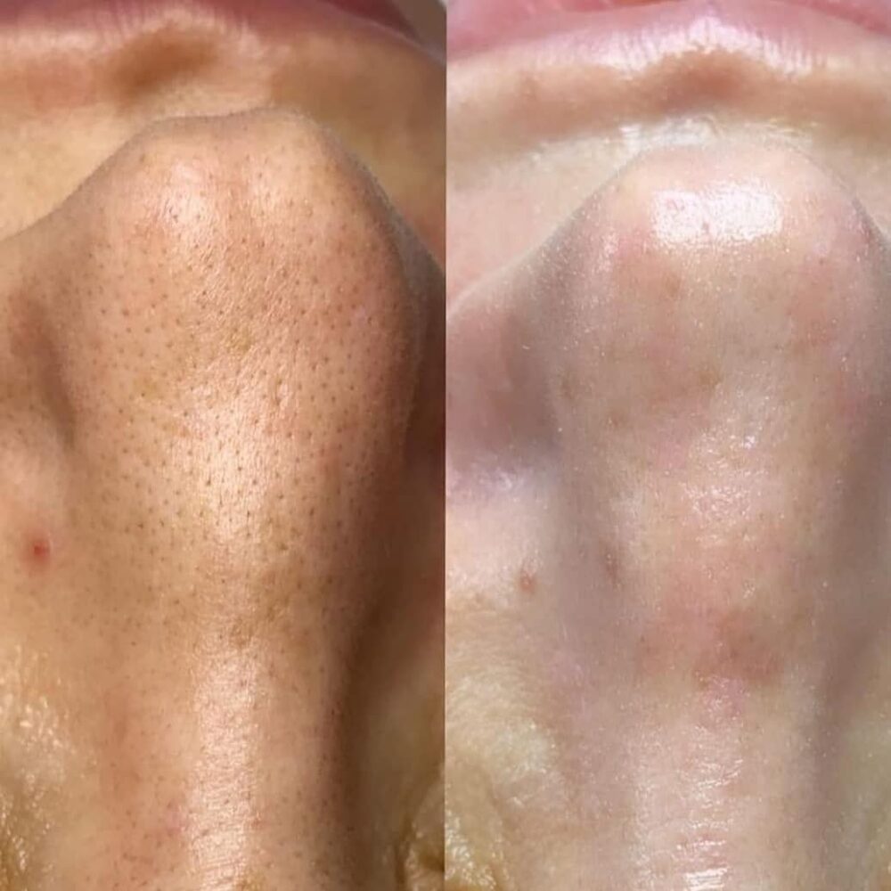 avant apres soin hydrafacial marseille