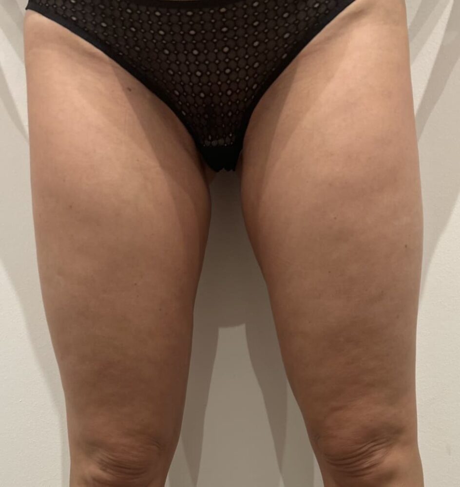après 8 séances de traitement cellulite des cuisses