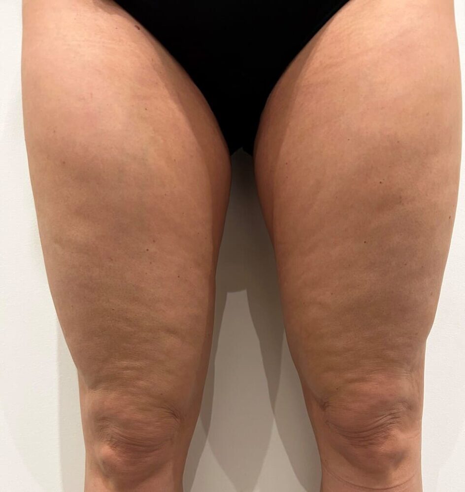 avant traitement cellulite des cuisses