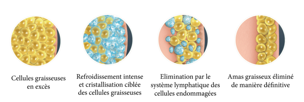 cryolipolyse aix en provence